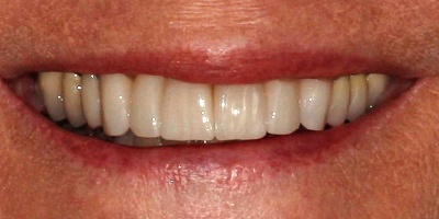 whitened teeth after