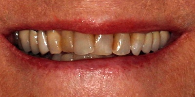 yellowed teeth before