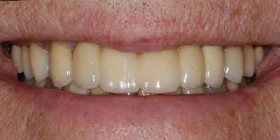 lightened teeth after