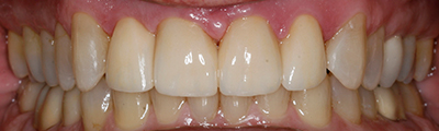 ungapped teeth after