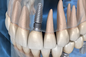 X-ray of a patient with a dental implant in their upper jaw 