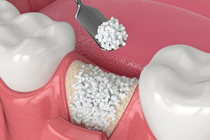 a digital illustration of bone grafting