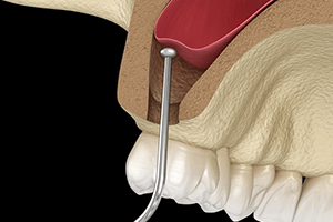 a digital illustration of a sinus lift procedure