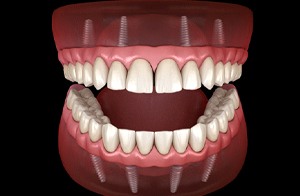 All-on-4 implants graphic