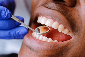 Closeup of patient during dental exam