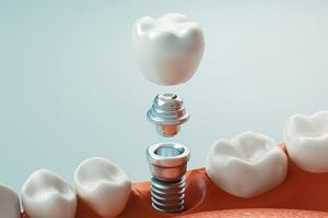 dental implant, abutment, and crown being placed in the bottom jaw