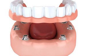 implant-retained dentures