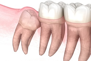 illustration of impacted wisdom teeth 