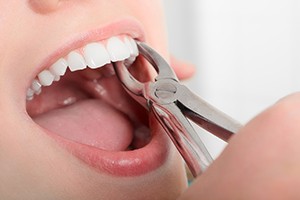 tooth extraction procedure