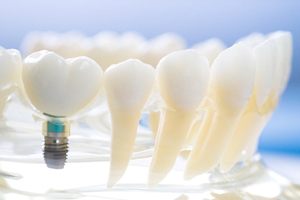 Model of single unit dental implant.