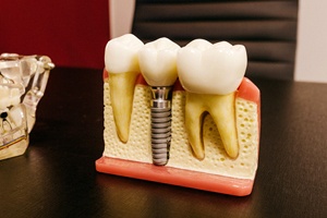 Model of a dental implant.