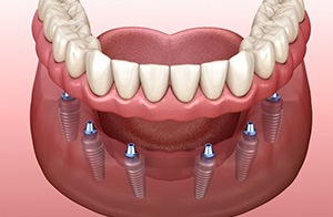 implant-retained dentures