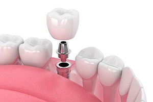 a digital illustration of a dental implant in Gainesville