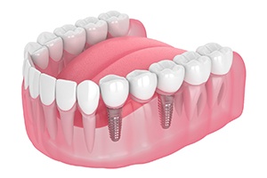 a digital illustration of a dental implant bridge in Gainesville