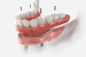 a digital illustration of dental implant dentures in Gainesville