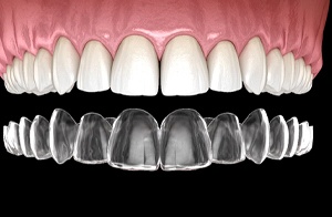 computer illustration of Invisalign trays going over teeth