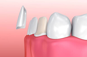 digital model of veneers