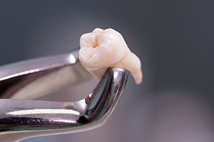 Metal clasp holding extracted tooth