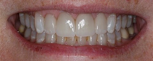gapped-filled and whitened teeth after