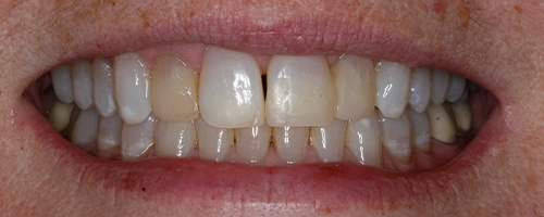 gapped and yellowed teeth before
