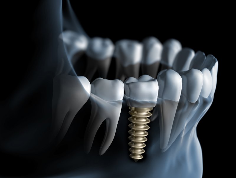 Dental implant replacing missing back tooth